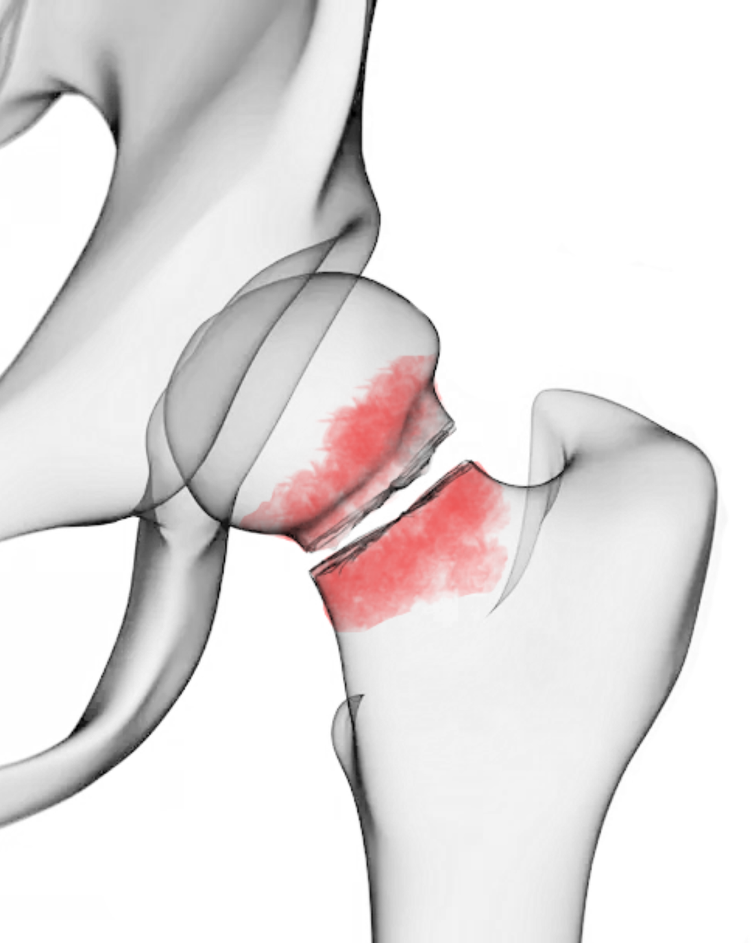 Illustration of a hip fracture, with the break across the femoral neck highlighted in red